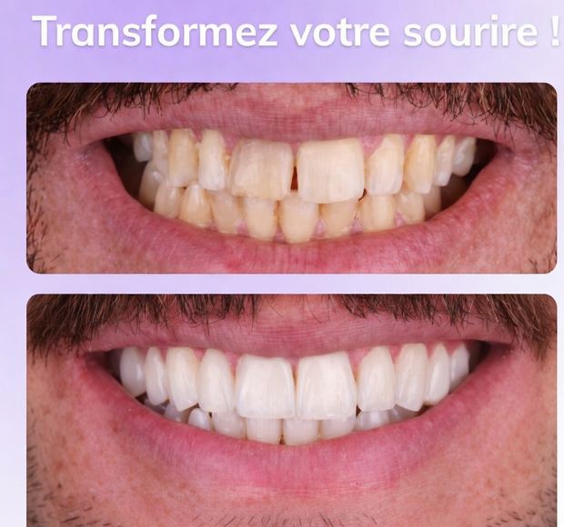 Facettes en porcelaine : le secret d’un sourire naturel