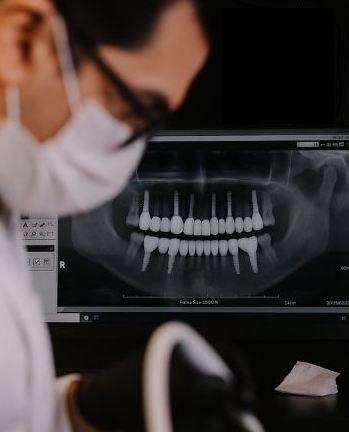 Les types d’implants dentaires : notre guide complet