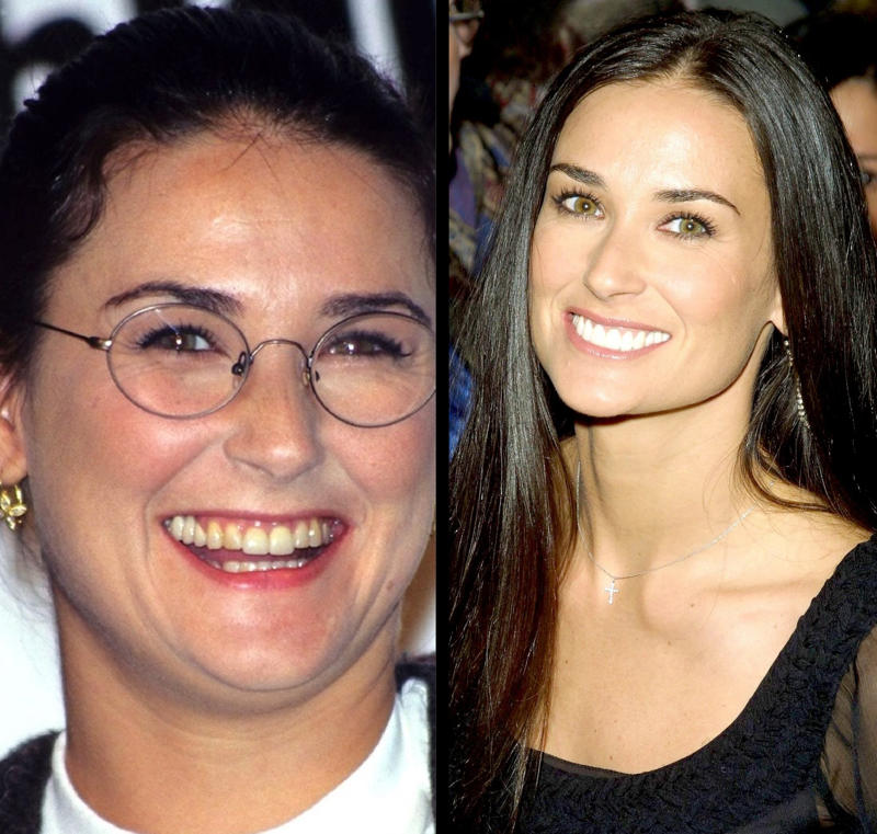 10 stars qui ont refait leurs dents Avant/Après