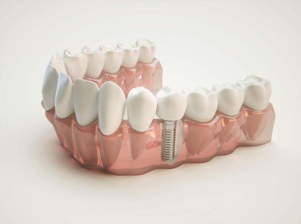 Pose d’implants et manque d’os : que faire ?