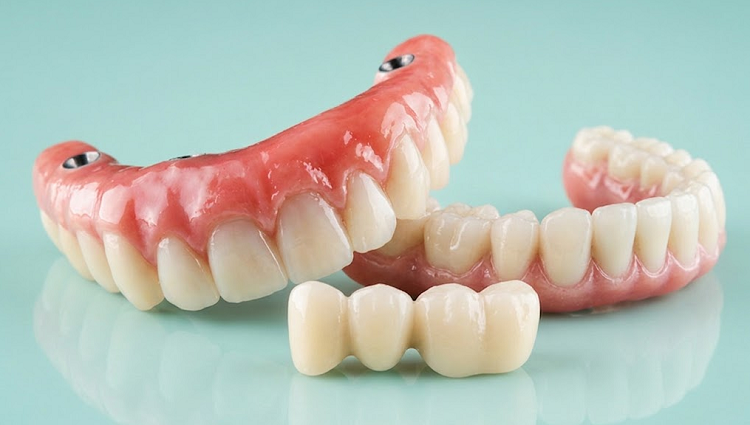 Restauration dentaire prothétique : solutions clés et avantages